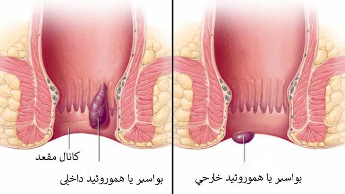 درمان بواسیر