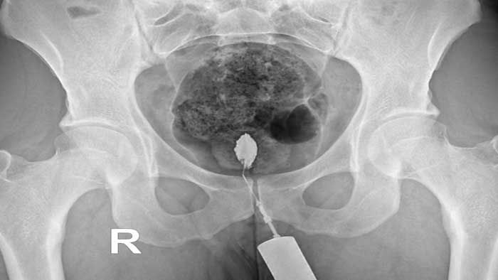 درمان بواسیر