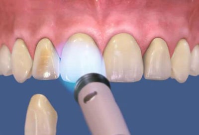 کامپوزیت دندان