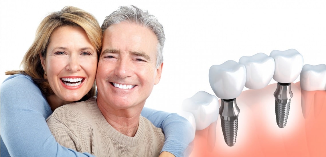 هزینه ایمپلنت