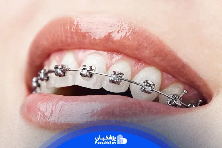 ارتودنسی برای چه کسانی مناسب است؟