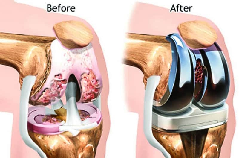 زانو مصنوعی