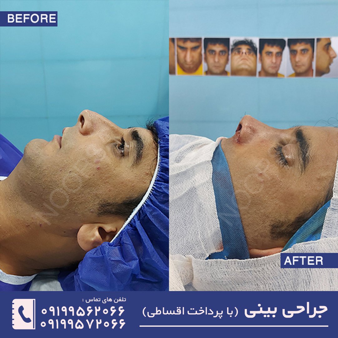 عمل بینی طبیعی