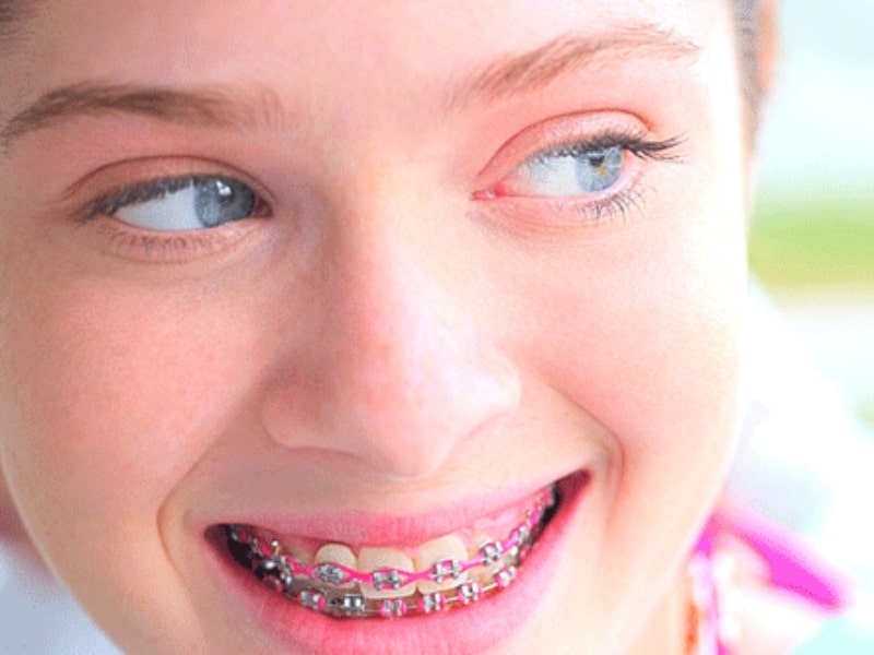 سن ارتودنسی