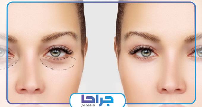 رفع افتادگی پلک