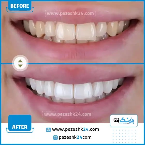 کامپوزیت دندان در کلینیک دندانپزشکی تهران