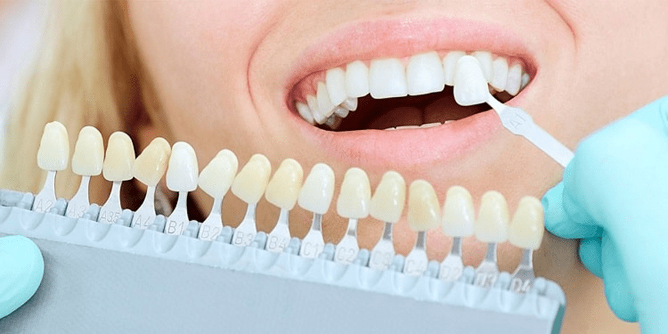 عکس انواع کامپوزیت دندان