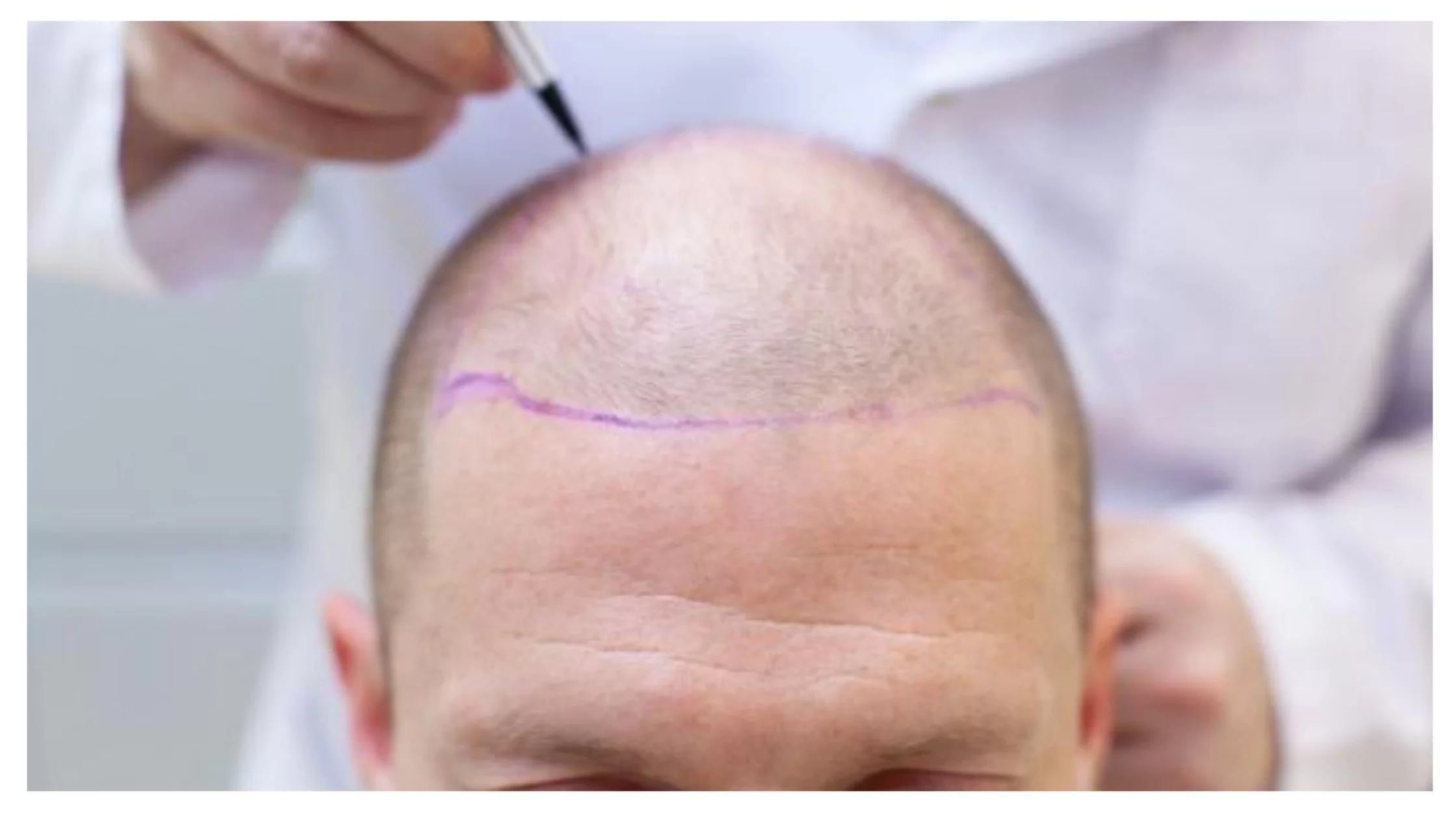 بنیانگذار کاشت مو و ابرو