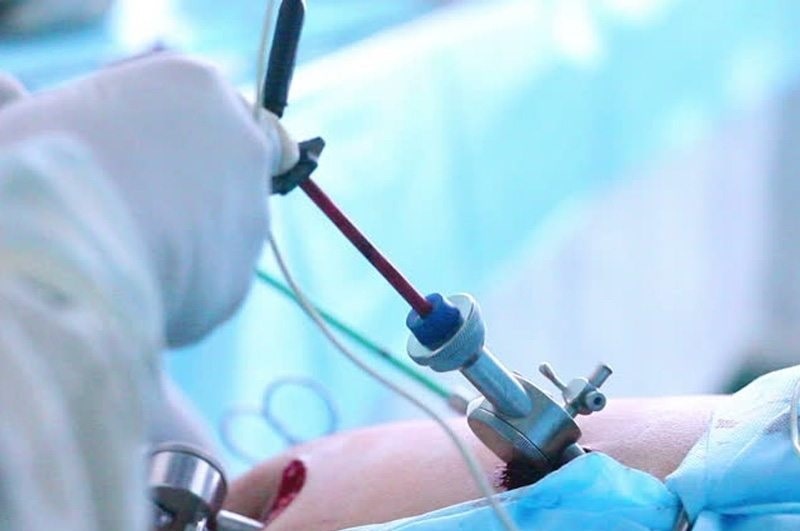 لاپاراسکوپی رحم