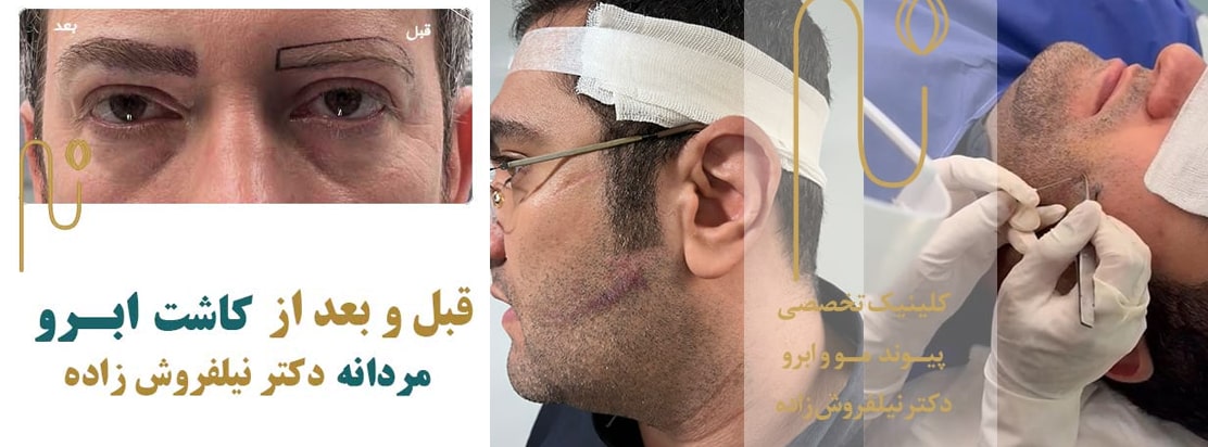 کاشت ریش و سبیل