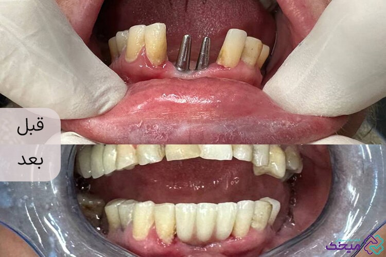 قیمت ایمپلنت