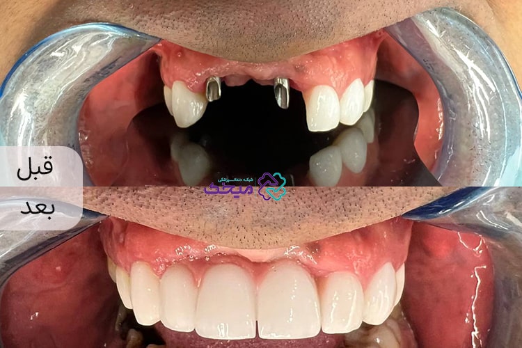 ایمپلنت فوری