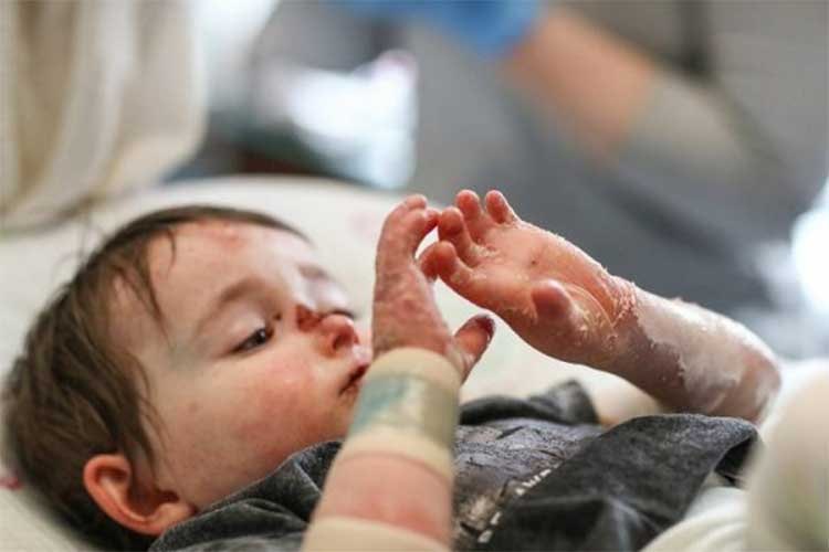 نحوه کمک‌رسانی به بیماران پروانه‌ای بی‌سرپرست