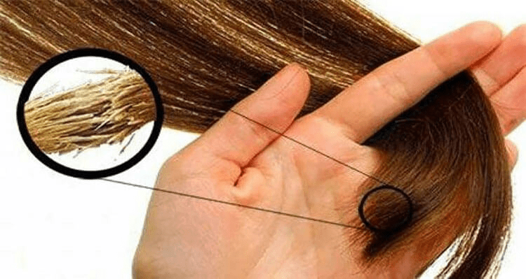 جلوگیری از موخوره