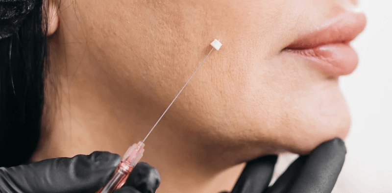 عوامل موثر بر ماندگاری لیفت با نخ