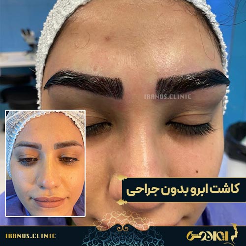 کاشت ابرو بدون جراحی