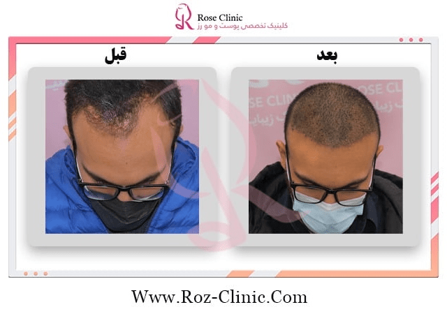 کاشت مو به روش تکثیر