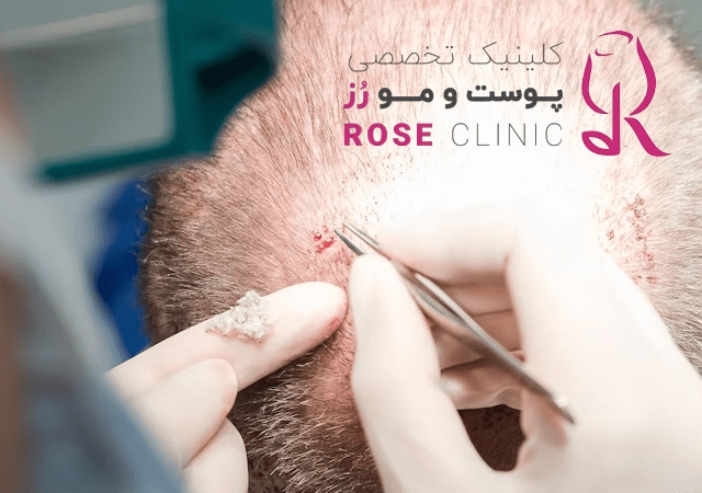 تکنیک کاشت مو SUT