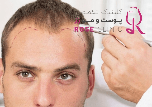 استفاده از بی‌ حسی در کاشت مو