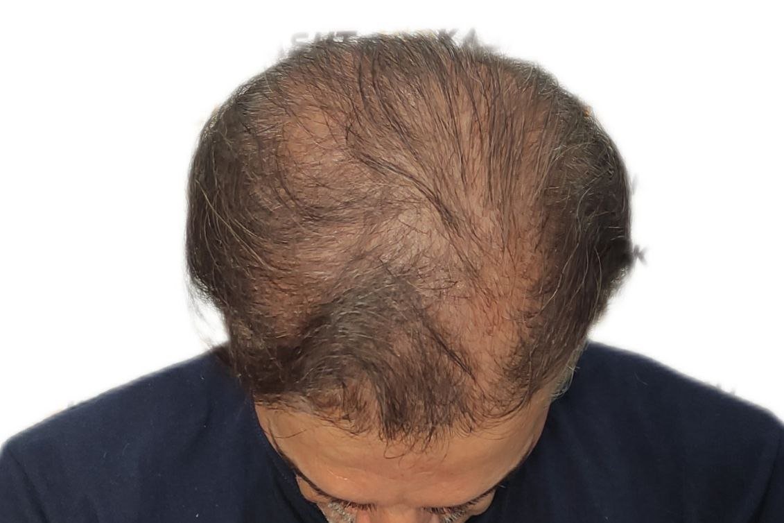 پشیمانی بعد از کاشت مو به دلیل تراکم پایین