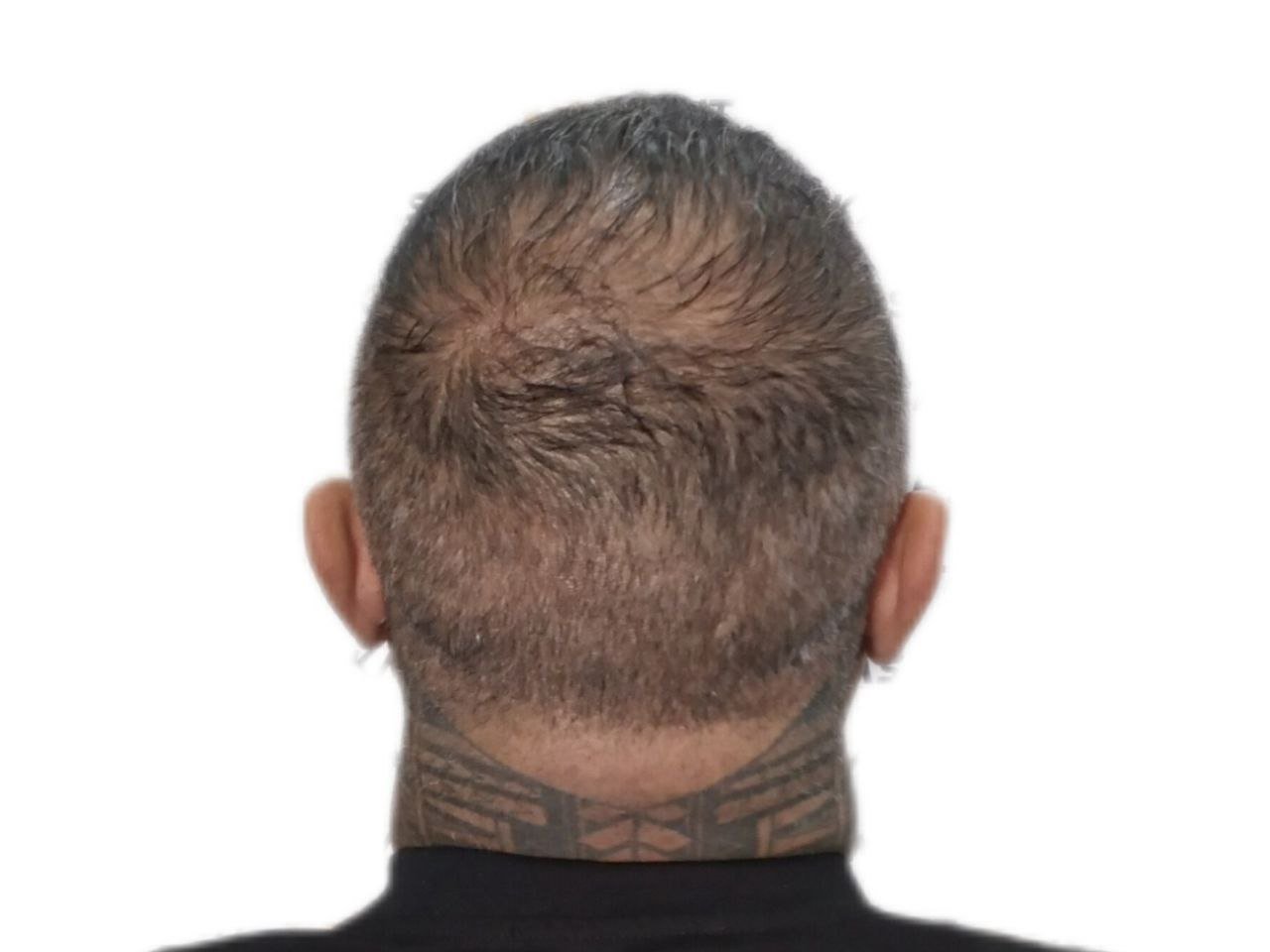 پشیمانی از کاشت مو به دلیل بانک موی ضعیف و انتظارات نامعقول