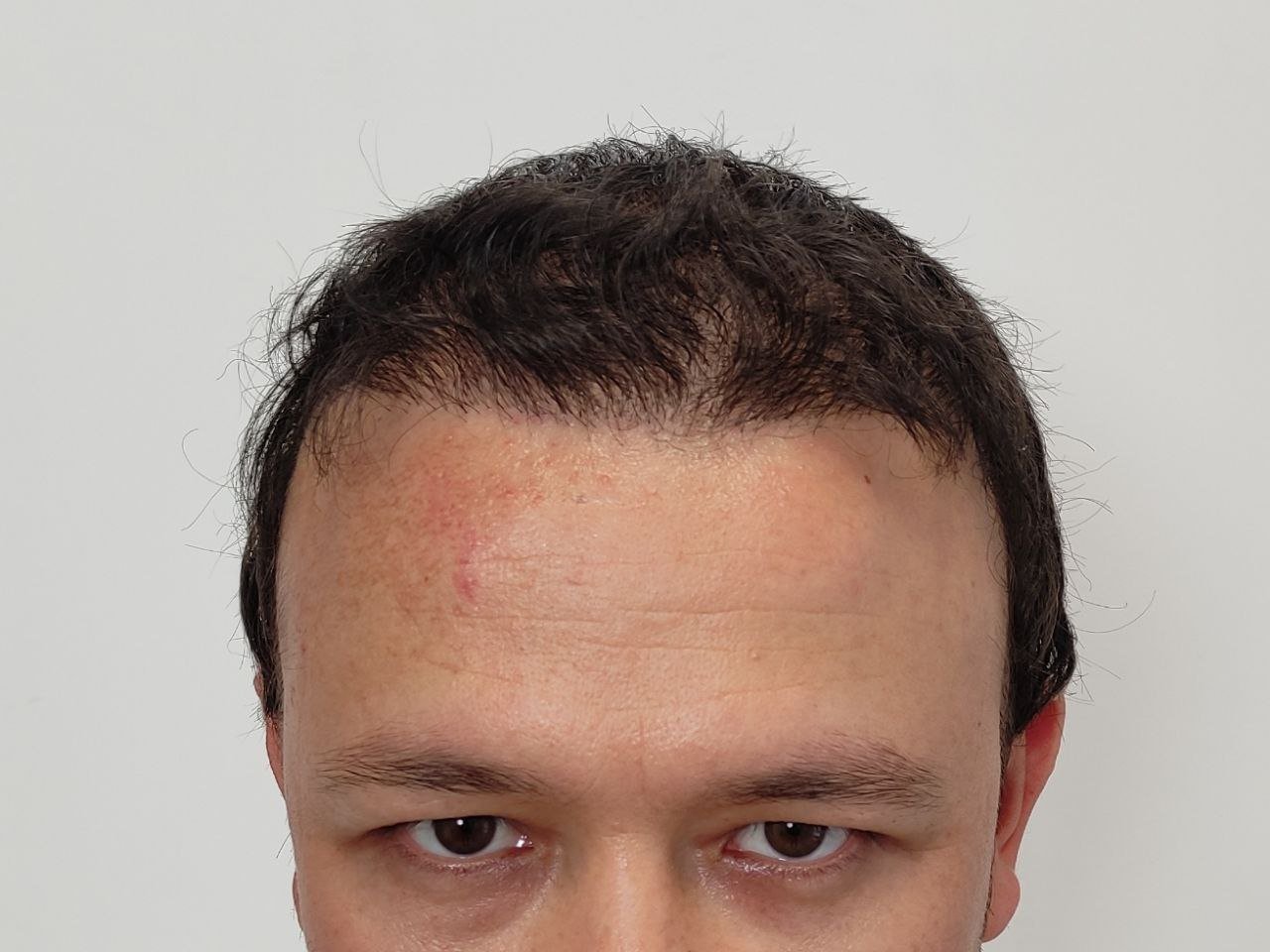 پشیمانی بعد از عمل کاشت مو به دلیل خط موی عروسکی