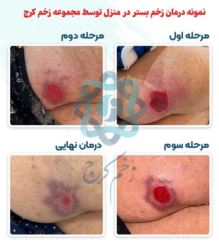 درمان زخم بستر در منزل