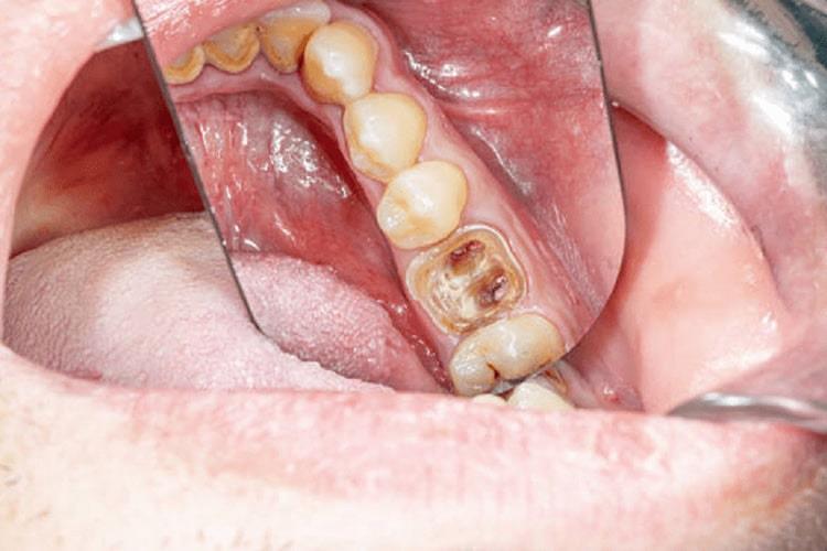 پوسیدگی دندان