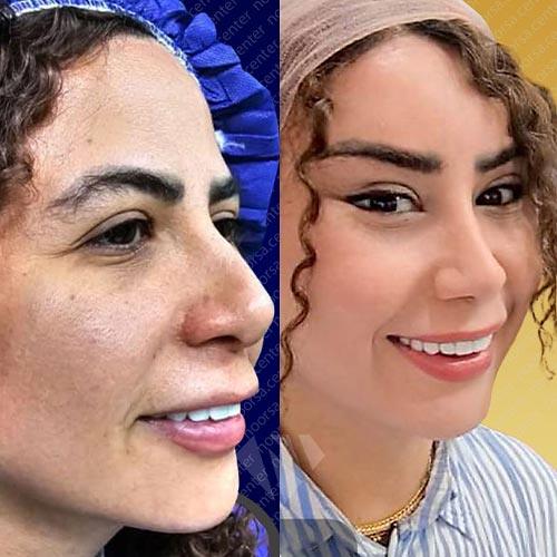 قبل و بعد از جراحی بینی