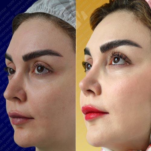 قبل و بعد از عمل بینی