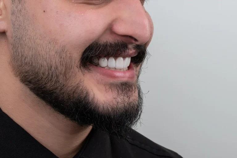 لمینت بهتره یا کامپوزیت