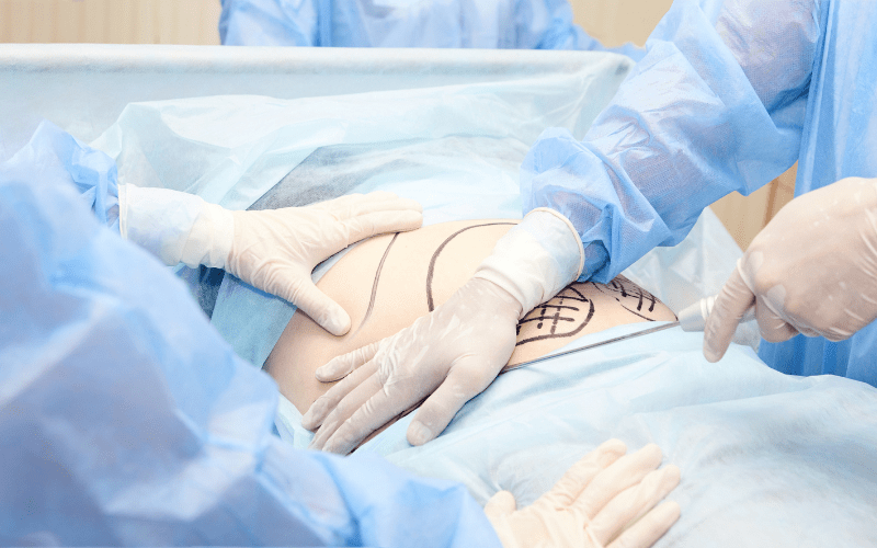 تاثیر شبکه‌های اجتماعی بر تقاضای لیپوساکشن