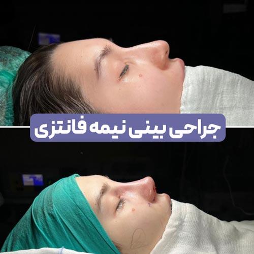 جراحی بینی نیمه فانتزی