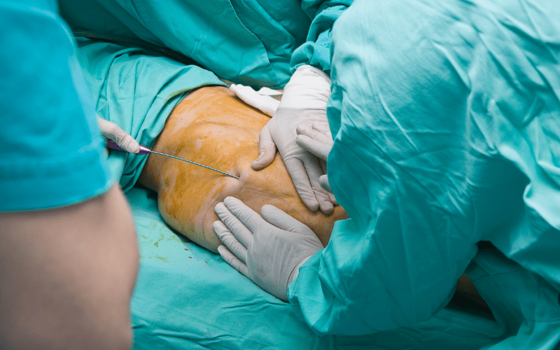 هزینه لیپوساکشن در ایران