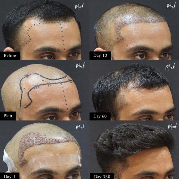 نتیجه کاشت مو