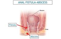 عوارض عمل جراحی فیستول مقعدی چیست؟