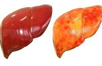 «تشریح» علت کبد چرب ایرانی ها در یک ویدیو