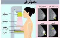 آغاز «هفته ماموگرافی رایگان» برای زنان از ۲۶ مهر تا ۳ آبان 1404