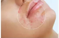 چرا بعد از لایه‌برداری پوست ممکن است جوش بزنیم؟