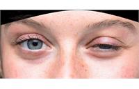 فاجعه خاموش دارویی برای بیماران «میاستنی گراویس»