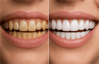 تراشیدن دندان برای لمینت چگونه است؟