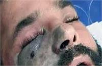 جولان کشنده «قارچ سیاه» در پاندمی کرونا