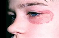 علت بروز قارچ سیاه «ضعف ایمنی» بدن است!