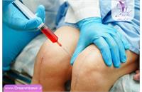 پی آر پی زانو؛ درمان نوین برای درد و آسیب مفصل با نتایج موثر و سریع