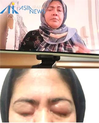 مرد افغان با اسید چشمان خواهر ۳۲ ساله‌اش را کور کرد