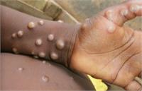 شدت یافتن توهم ابتلا به آبله میمون/شیوع بیماری مسری در ایران+تصویر