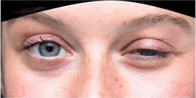 فاجعه خاموش دارویی برای بیماران «میاستنی گراویس»