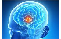 هفت علامت هشداردهنده تومور مغزی که نباید نادیده بگیرید!