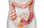 سرطان روده بزرگ یا Colon Cancer چیست؟