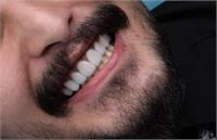 کامپوزیت انجام بدم یا لمینت؟ راهنمای کامل انتخاب بهترین روش اصلاح طرح لبخند